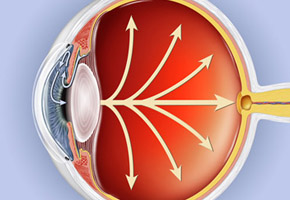 glaucoma_eye.jpg