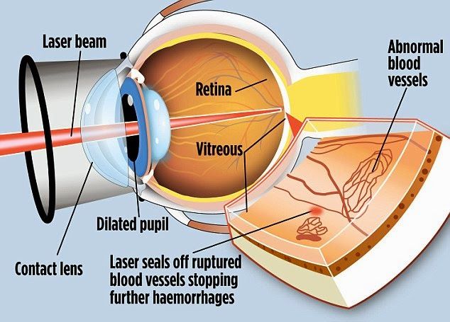 lasik eye surgery risk factors.jpg