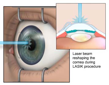 lasik-eye-surgery.jpg