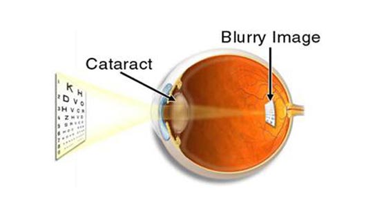 Cataract.jpg