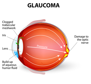glaucoma-small