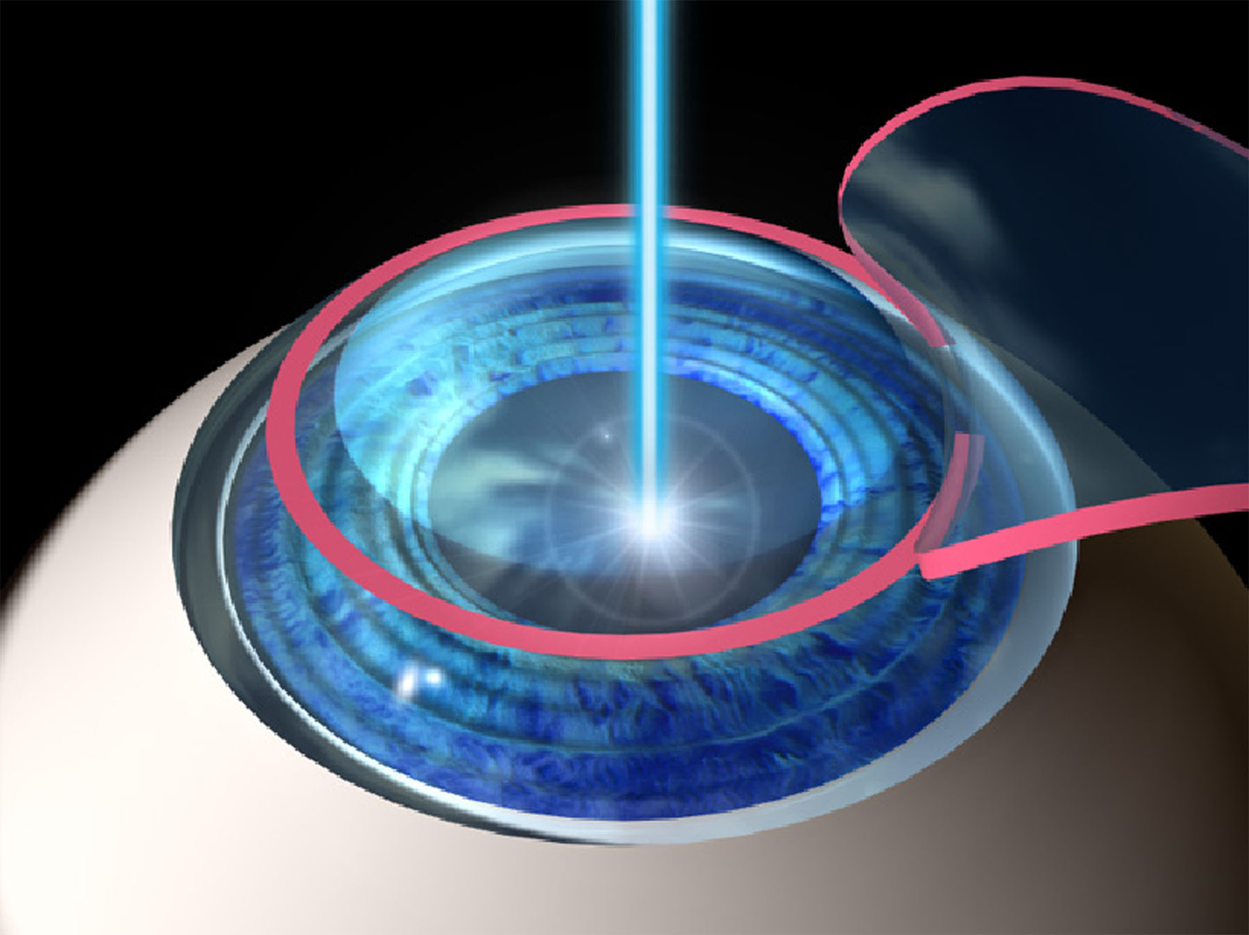 Laser-Eye-Surgery.jpg