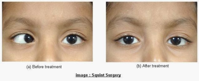 squint-surgery-cost-in-india-637x261