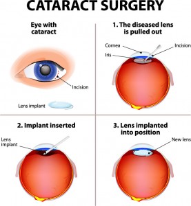 Cataract-Surgery-277x300.jpg