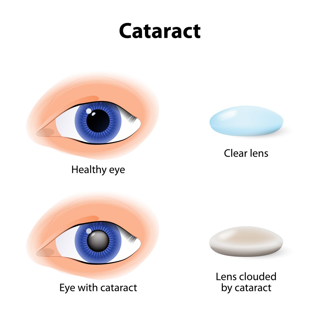 Cataract-visual-1024x1024.jpg