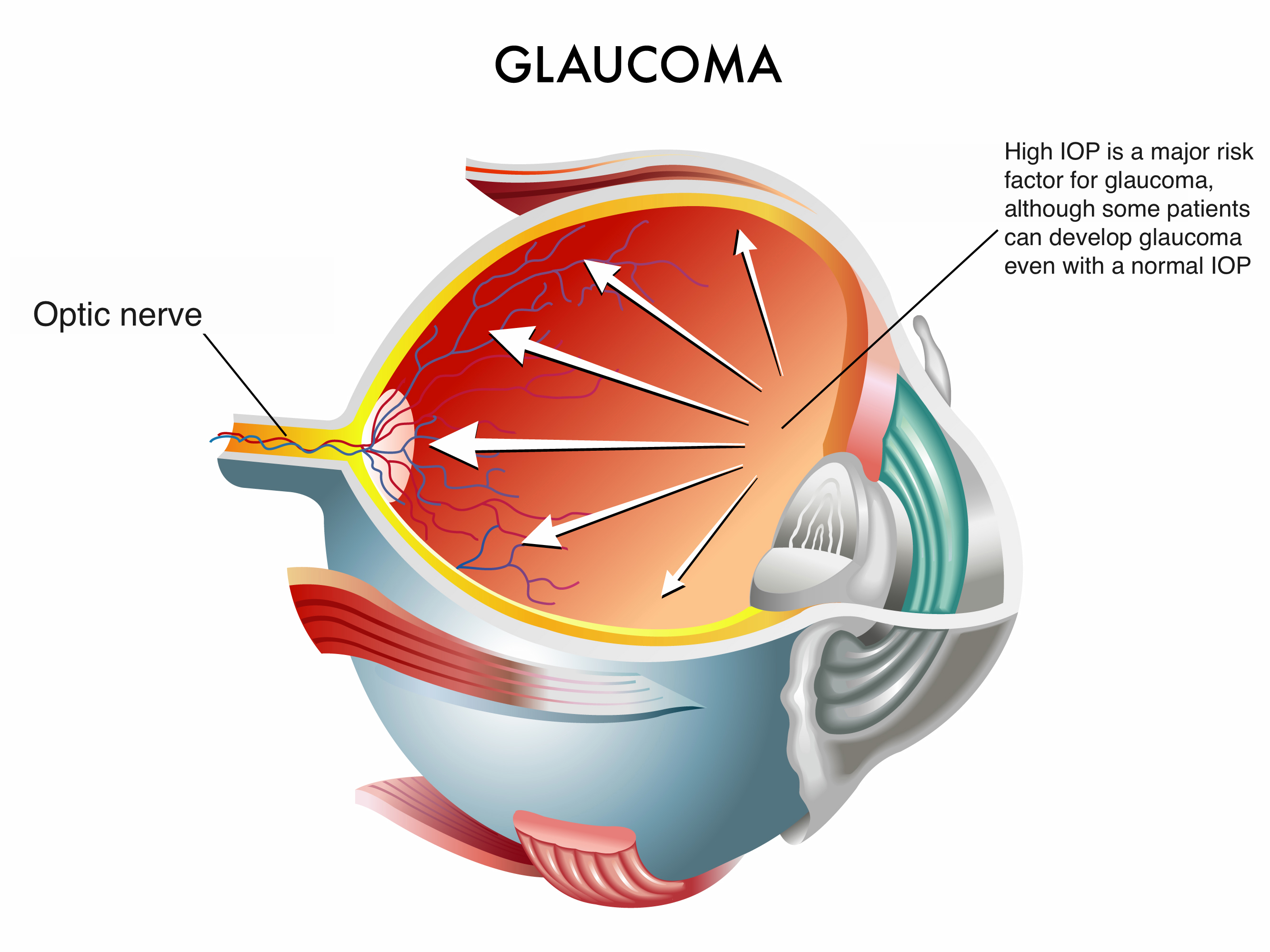 Glaucoma1.jpg