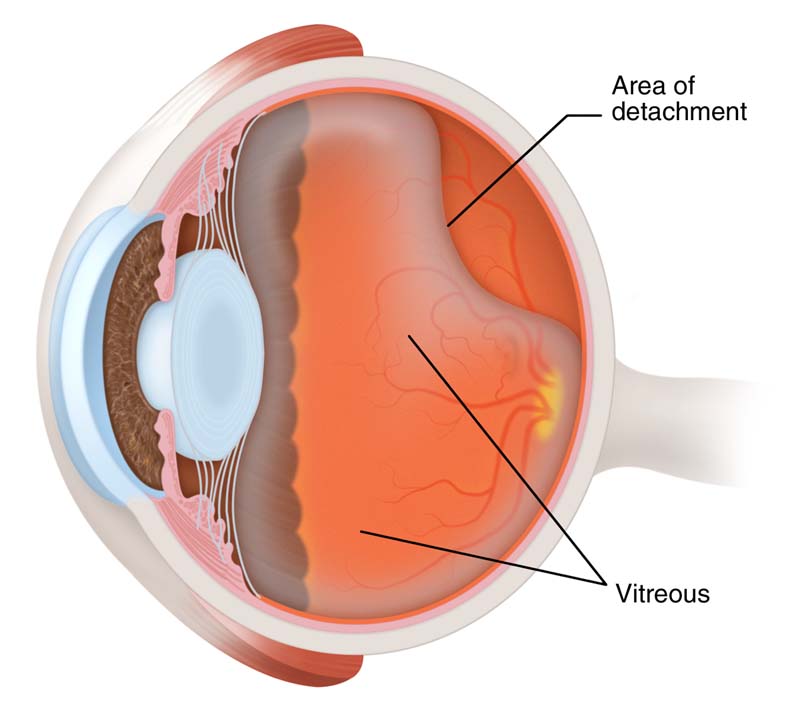 posterior-vitreous-detachment